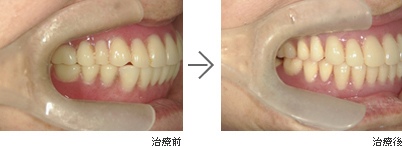 入れ歯治療の治療前、治療後の比較写真
