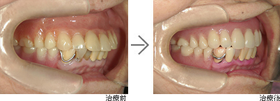 治療前と治療後の比較 入れ歯・歯周病治療　80代女性
