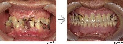 し歯・歯周病治療・義歯作製　(60代男性）の写真