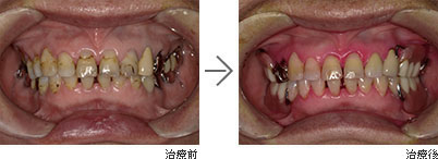 セラミックの歯・ステインオフ・精密義歯・マウスピース（自費）、むし歯・歯周病治療（保険）/70代女性の治療前、治療後