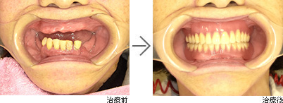 口腔内の画像 歯ぐきの移植後
