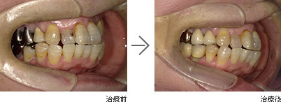 セラミックの歯（自費）むし歯・歯周病治療（保険）/60代女性の画像