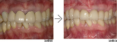 限局的歯列矯正・歯肉移植術・セラミック被せもの / 40代女性の感想