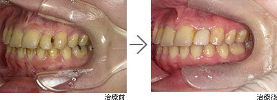 むし歯・歯周病治療・親知らずの抜歯・マウスピース作製 / 30代女性の治療後感想