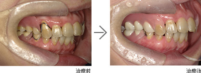 むし歯・歯周病治療（保険）、精密義歯（自費） / 50代女性の治療前治療後写真