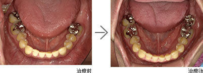 インプラント治療 / 40代男性の治療前、治療後