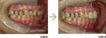 歯周病・むし歯治療 / 70代女性の治療後写真